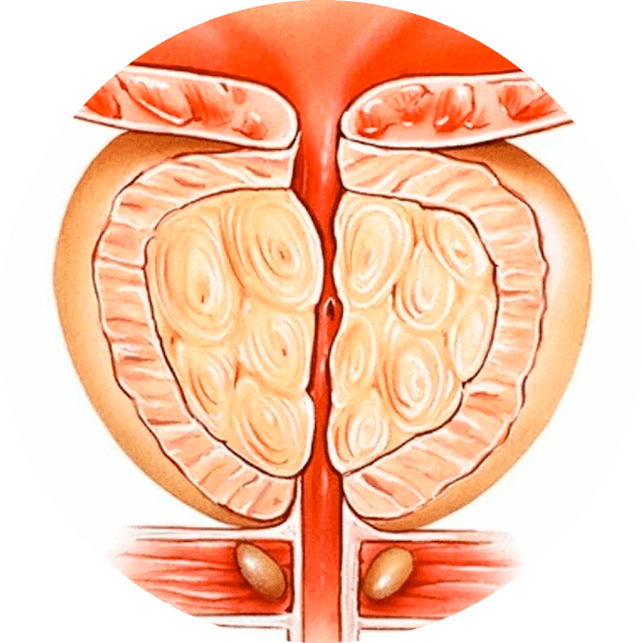 Conséquences d'une prostatite non traitée