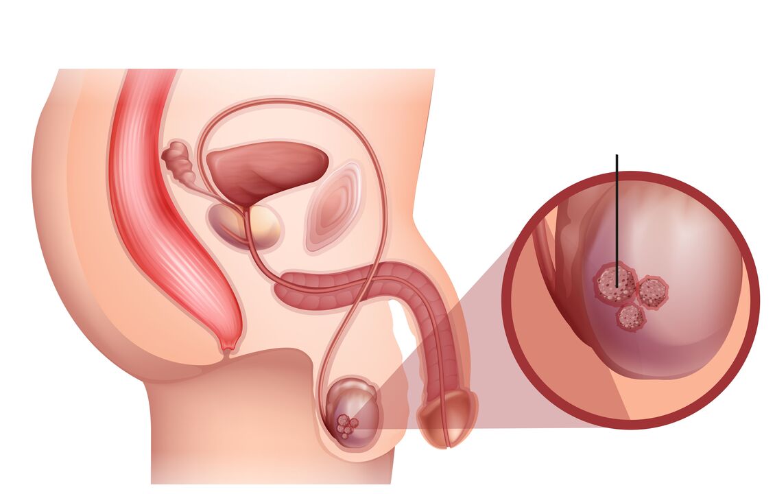 Signes de cancer de la prostate