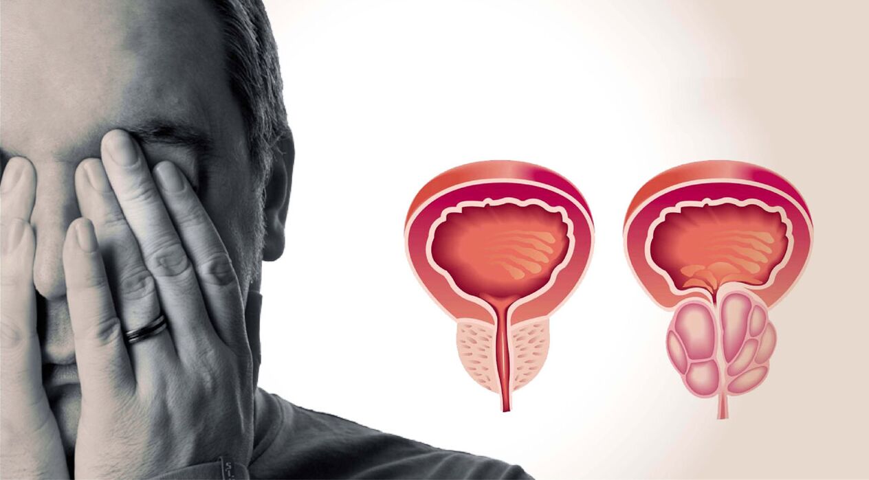 prostatite chronique chez les hommes