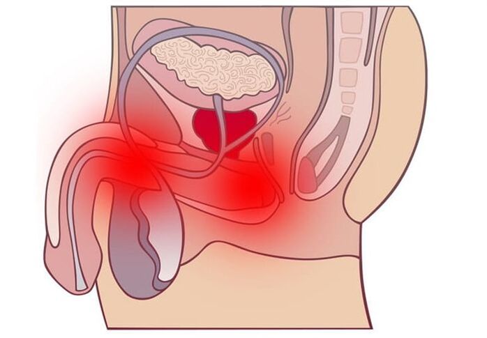 Méthodes de traitement de la prostatite